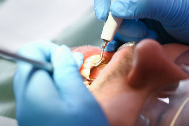 Best Emergency Dental Care for Sports Injuries in Avalon, NJ